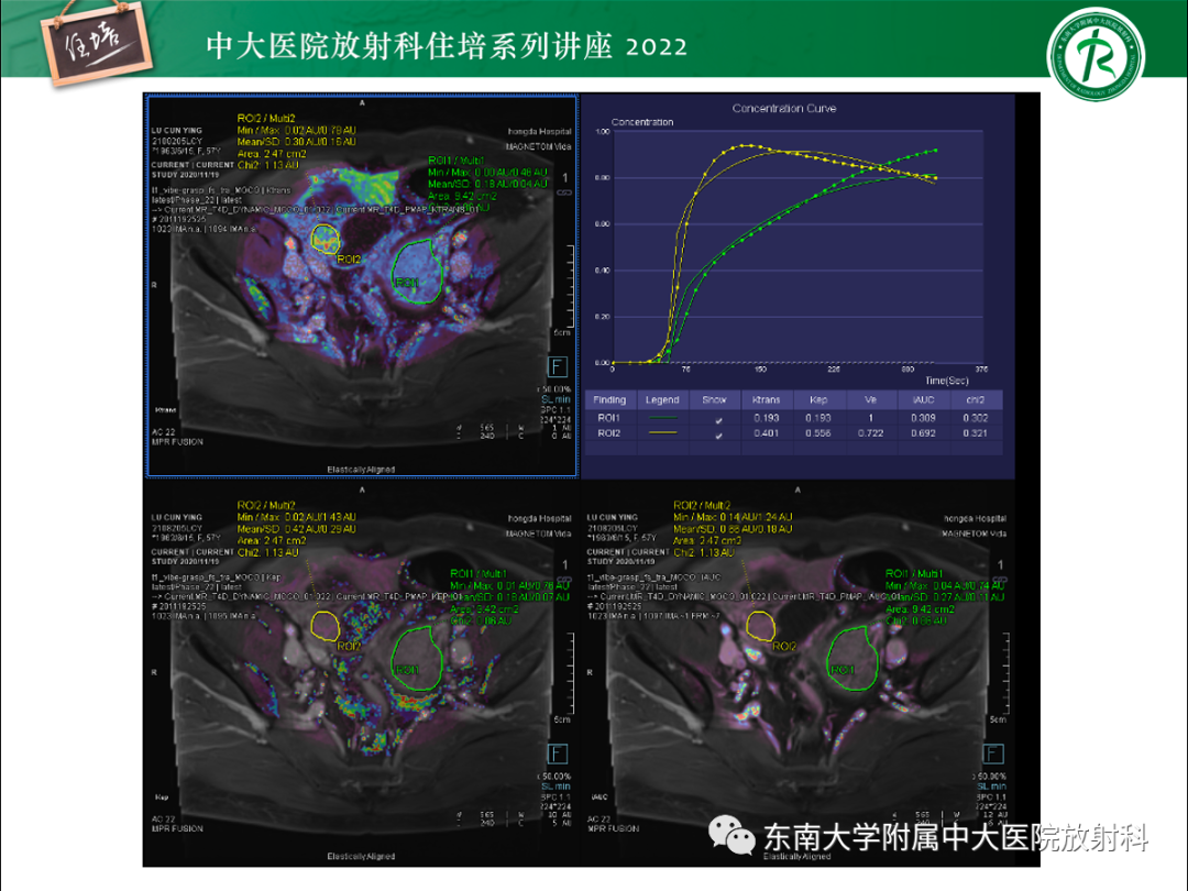 影像PPT - 【PPT】附件病变磁共振评分系统MRI O-RADS-37