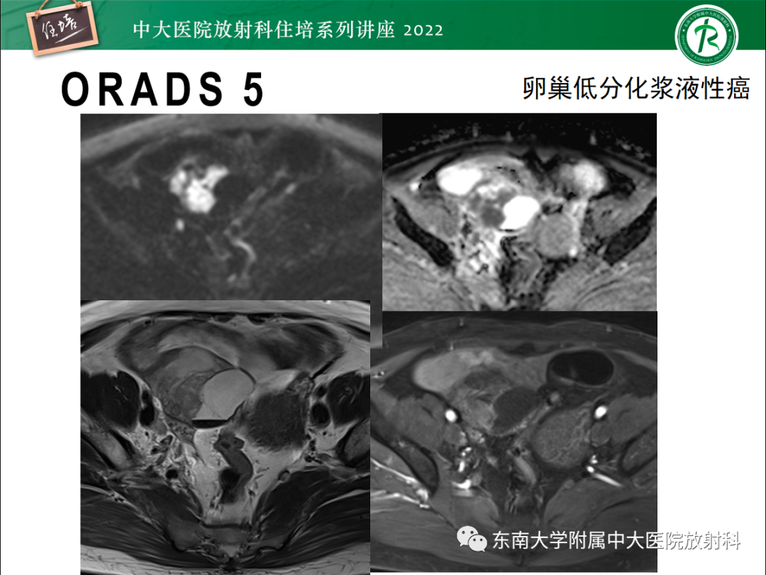 影像PPT - 【PPT】附件病变磁共振评分系统MRI O-RADS-38