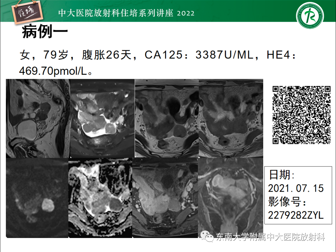 影像PPT - 【PPT】附件病变磁共振评分系统MRI O-RADS-43
