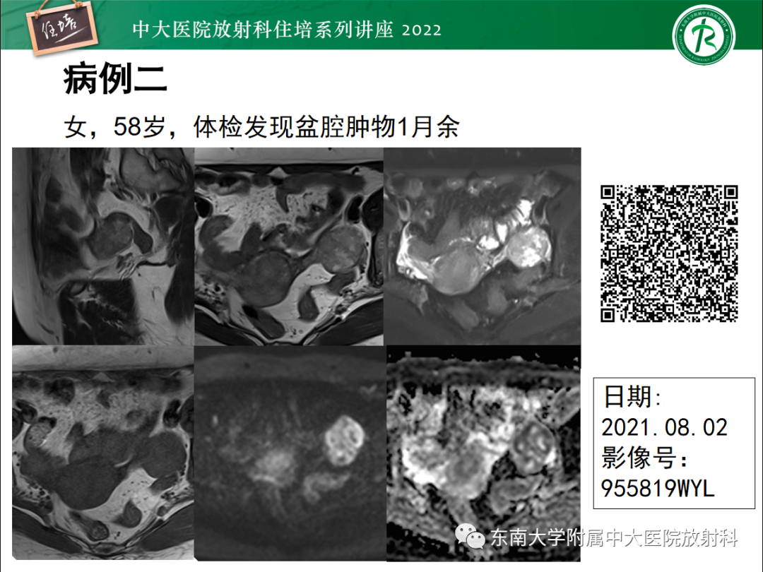 影像PPT - 【PPT】附件病变磁共振评分系统MRI O-RADS-45