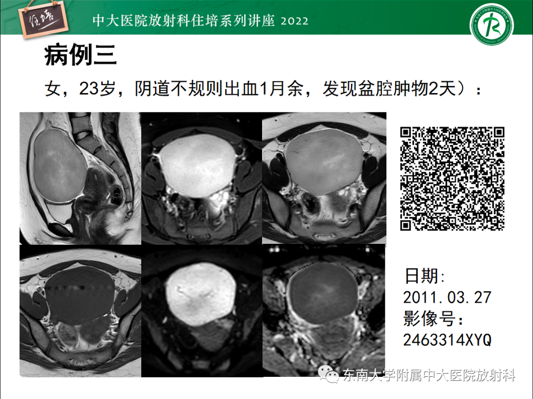 影像PPT - 【PPT】附件病变磁共振评分系统MRI O-RADS-47