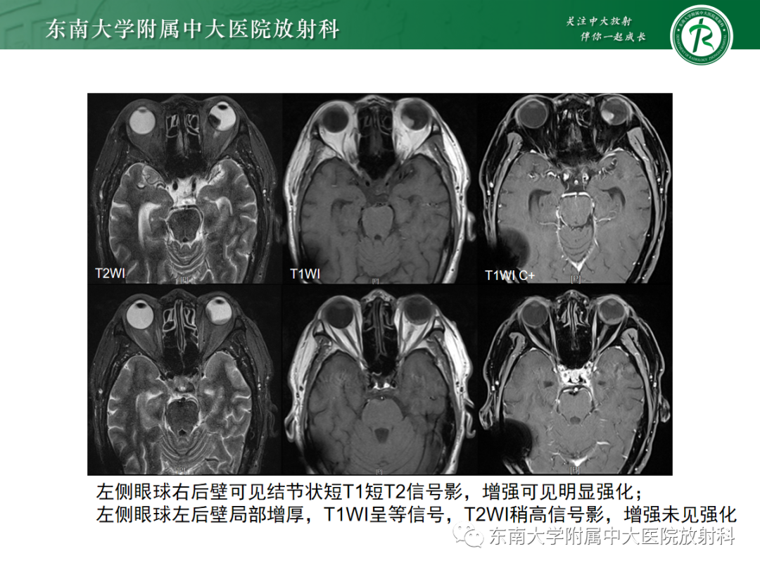 影像PPT - 【PPT】脉络膜黑色素瘤-2