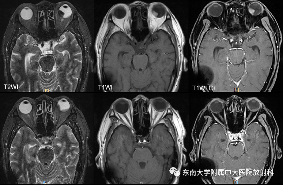 影像PPT - 【PPT】脉络膜黑色素瘤-1