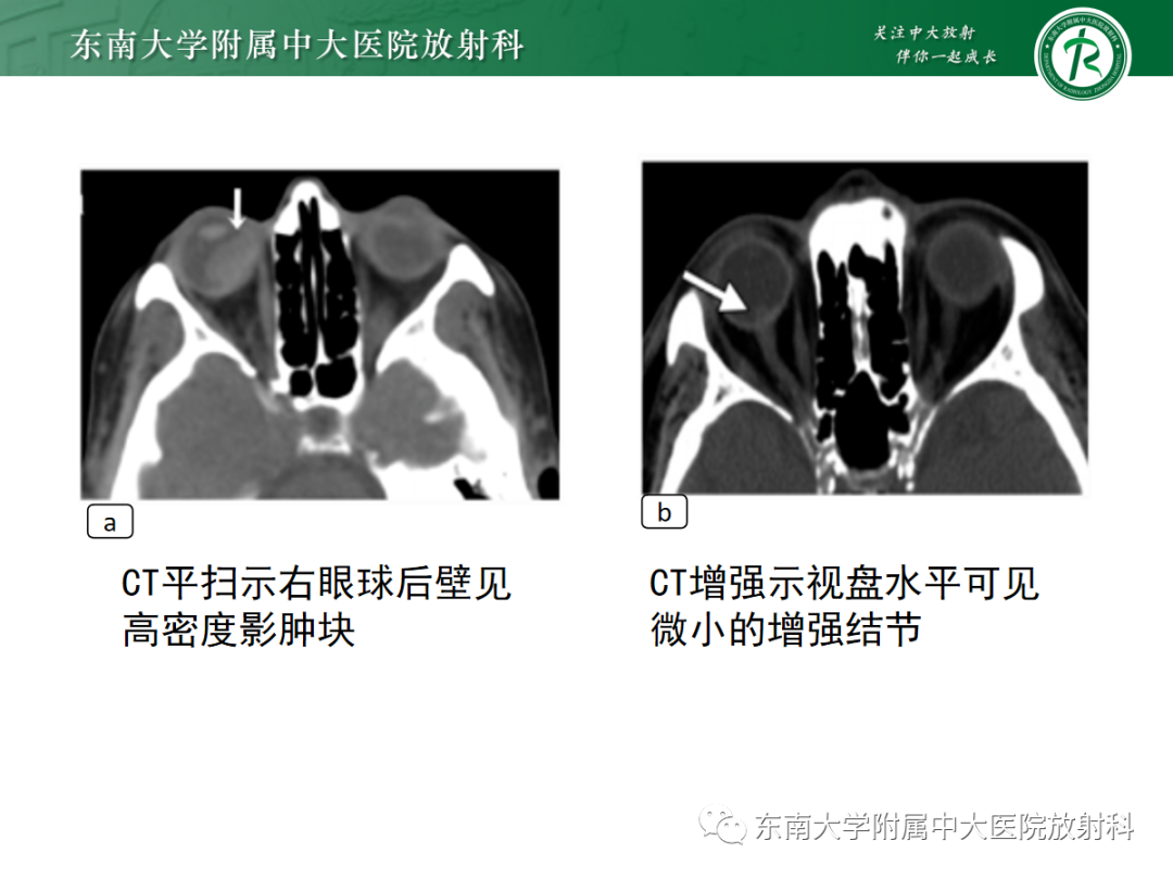 影像PPT - 【PPT】脉络膜黑色素瘤-10