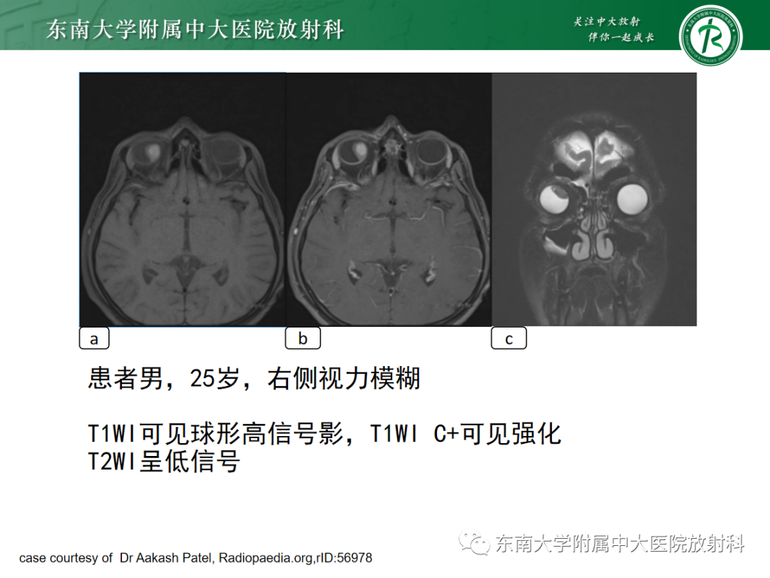影像PPT - 【PPT】脉络膜黑色素瘤-12