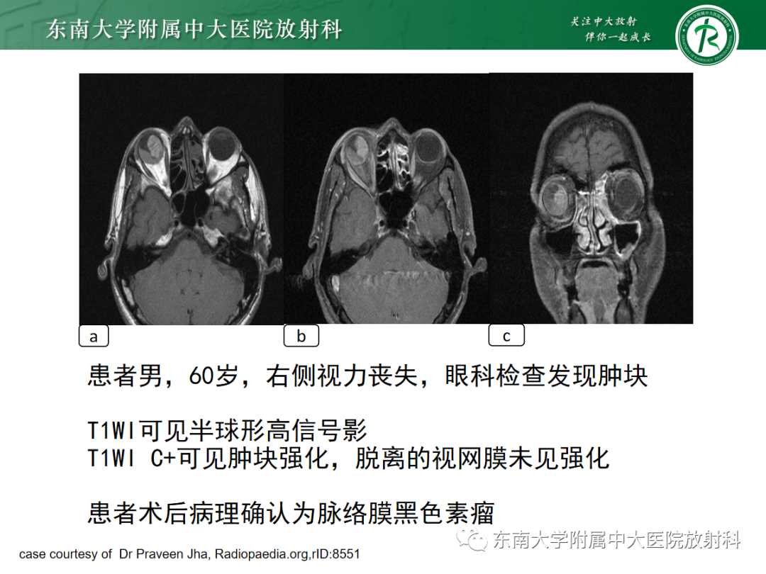 影像PPT - 【PPT】脉络膜黑色素瘤-13