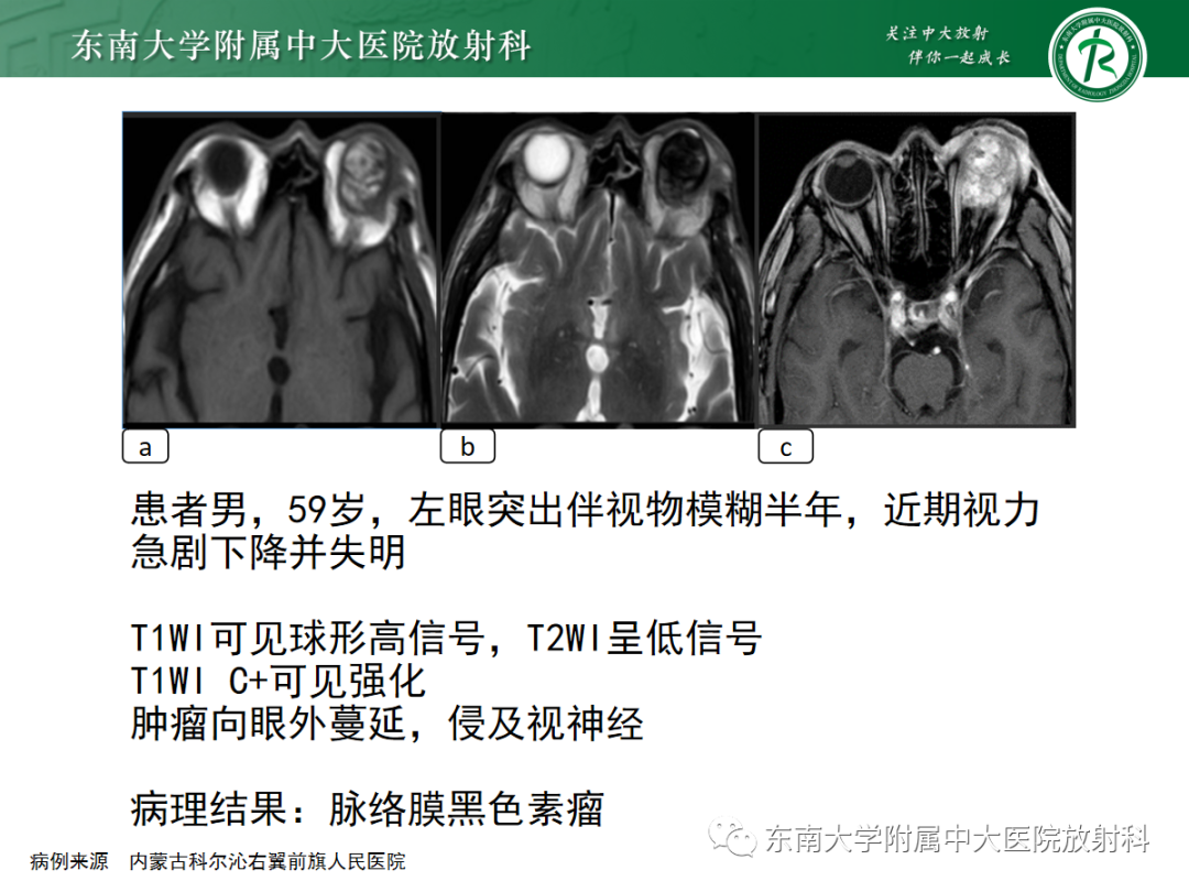 影像PPT - 【PPT】脉络膜黑色素瘤-14