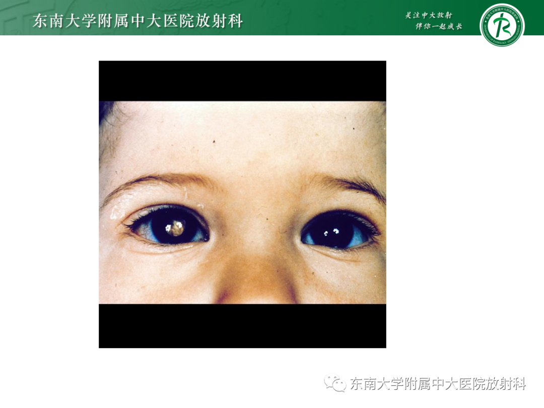 影像PPT - 【PPT】脉络膜黑色素瘤-18