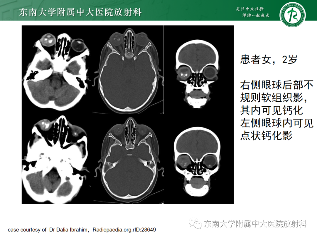 影像PPT - 【PPT】脉络膜黑色素瘤-20