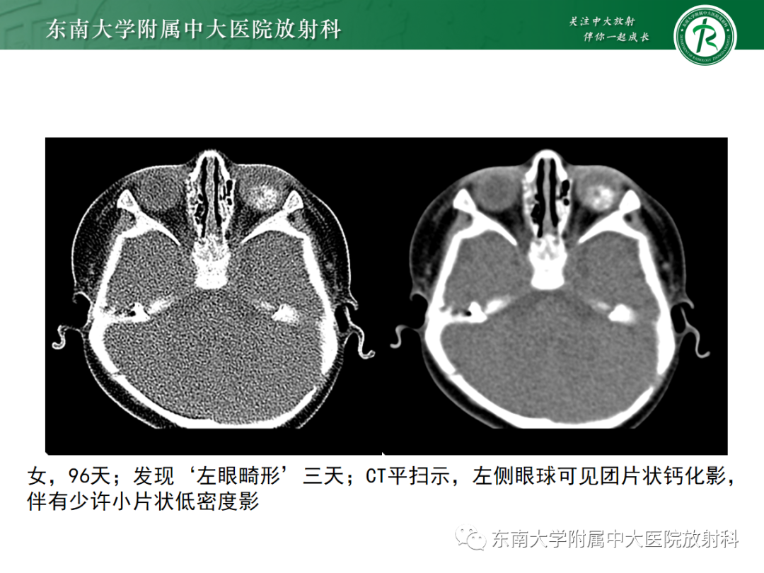 影像PPT - 【PPT】脉络膜黑色素瘤-23