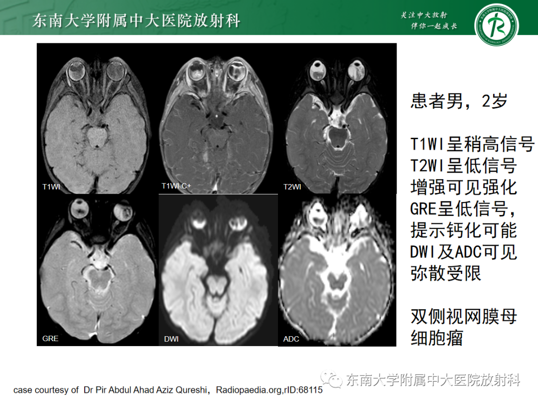影像PPT - 【PPT】脉络膜黑色素瘤-22