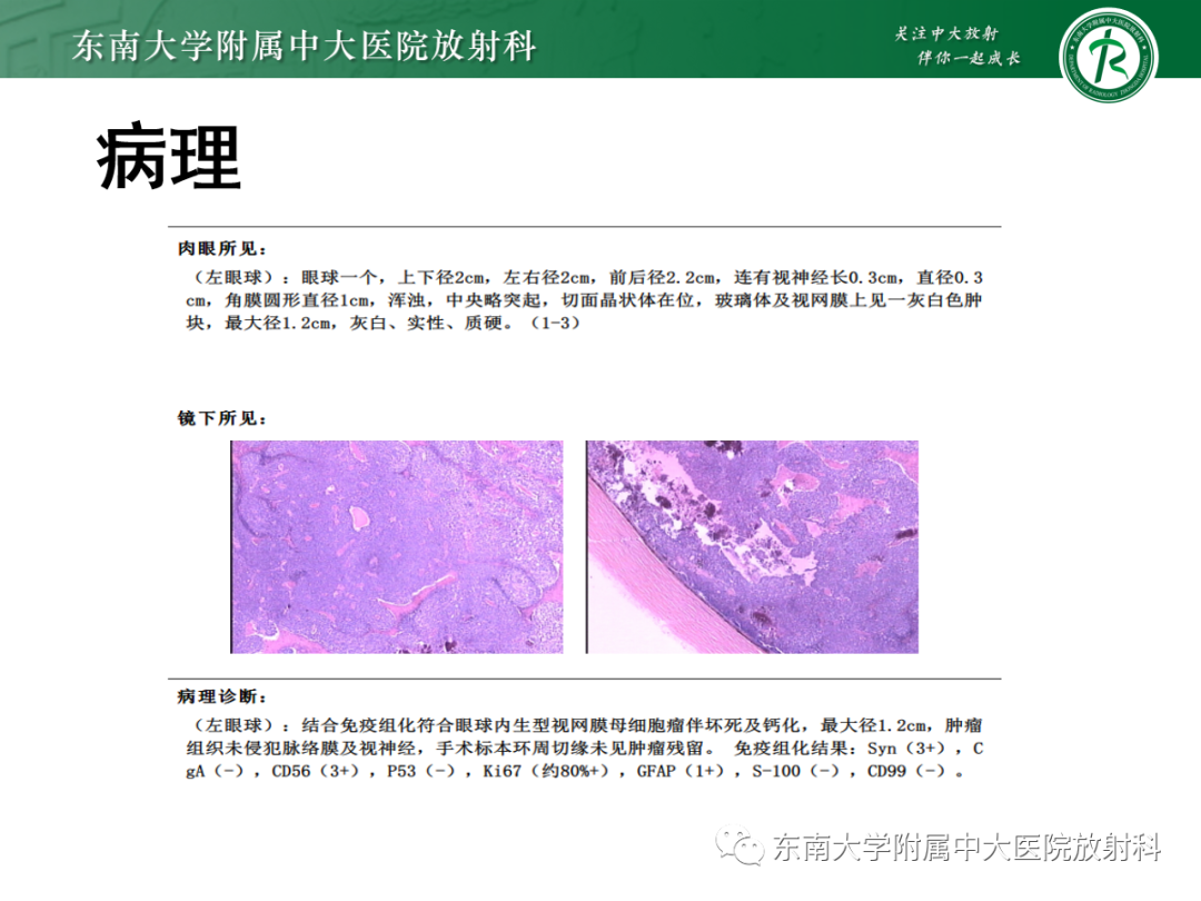 影像PPT - 【PPT】脉络膜黑色素瘤-25