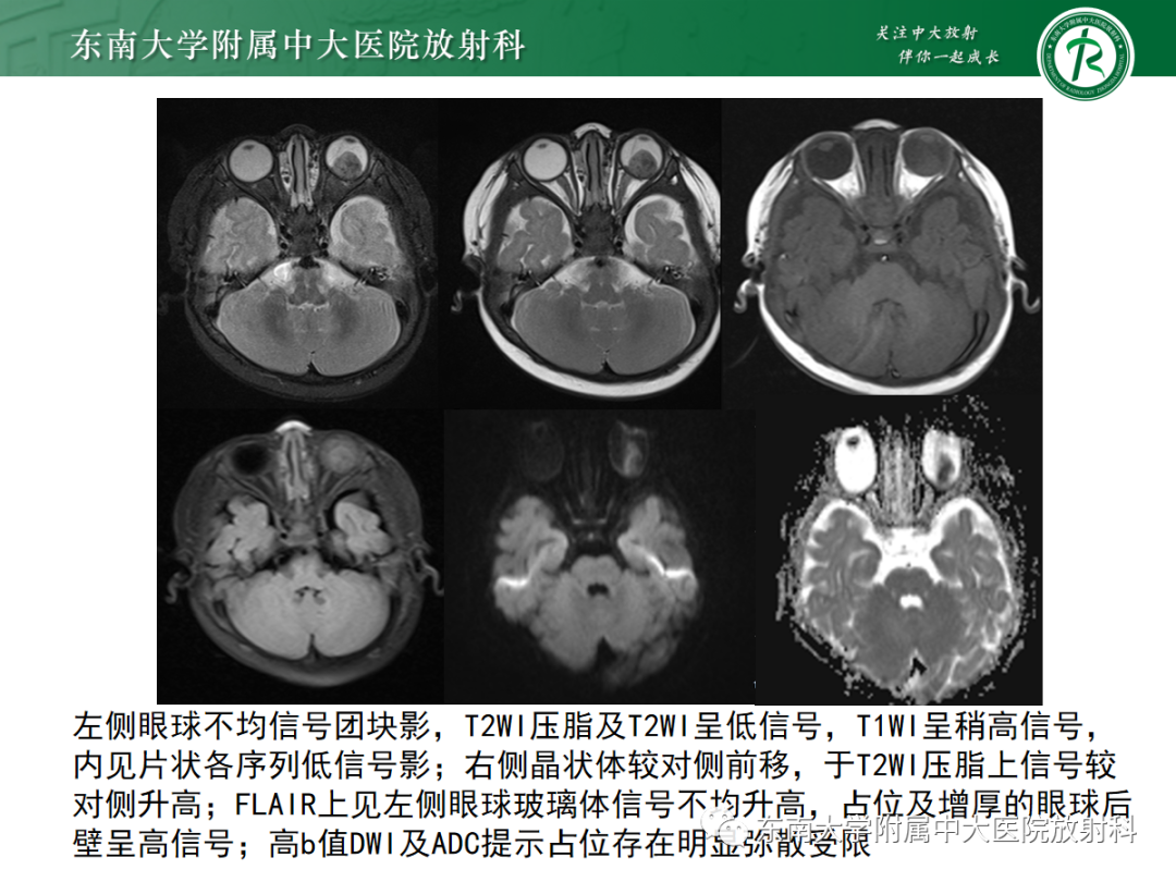 影像PPT - 【PPT】脉络膜黑色素瘤-24