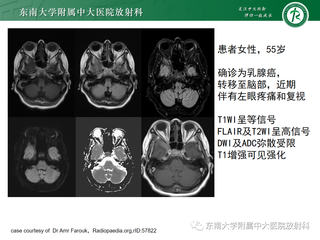 影像PPT - 【PPT】脉络膜黑色素瘤-27