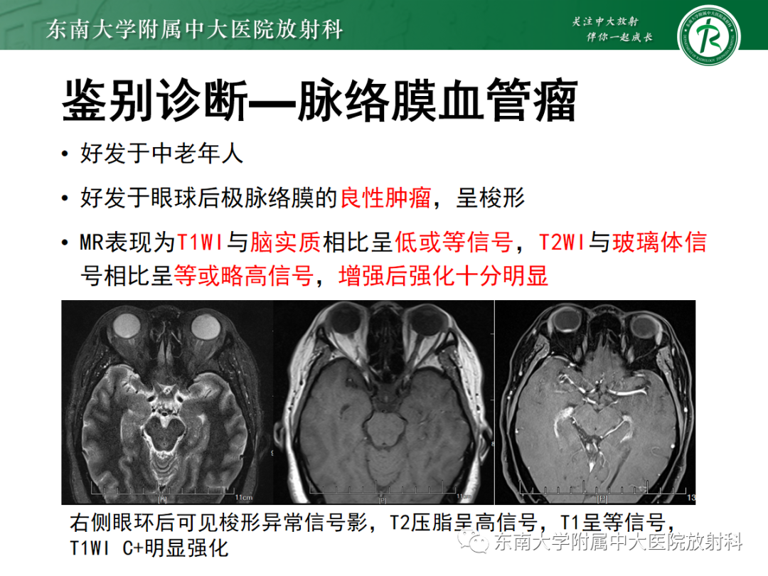 影像PPT - 【PPT】脉络膜黑色素瘤-28