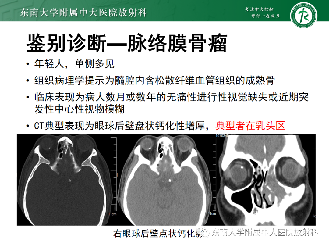影像PPT - 【PPT】脉络膜黑色素瘤-29