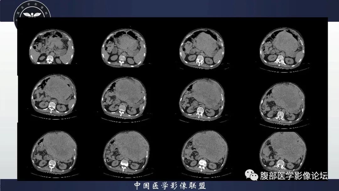 影像PPT - 【病例】腹腔恶性孤立性纤维性肿瘤1例CT影像-8