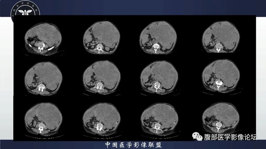 影像PPT - 【病例】腹腔恶性孤立性纤维性肿瘤1例CT影像-9
