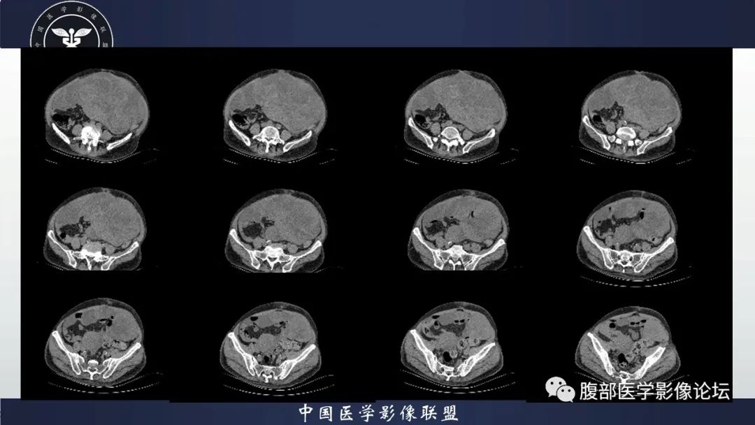 影像PPT - 【病例】腹腔恶性孤立性纤维性肿瘤1例CT影像-10