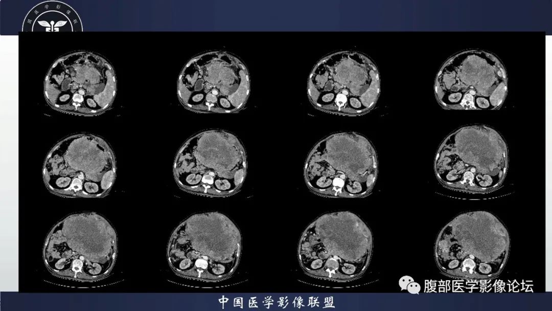 影像PPT - 【病例】腹腔恶性孤立性纤维性肿瘤1例CT影像-12