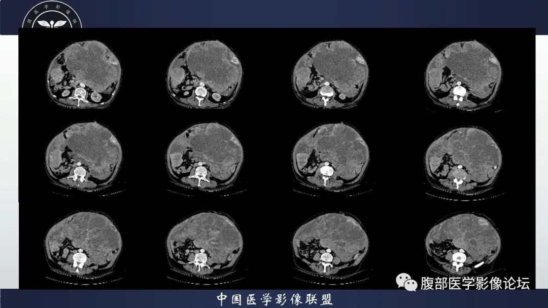 影像PPT - 【病例】腹腔恶性孤立性纤维性肿瘤1例CT影像-13