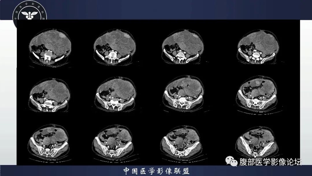 影像PPT - 【病例】腹腔恶性孤立性纤维性肿瘤1例CT影像-14
