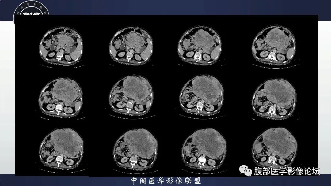 影像PPT - 【病例】腹腔恶性孤立性纤维性肿瘤1例CT影像-16