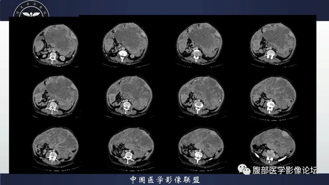 影像PPT - 【病例】腹腔恶性孤立性纤维性肿瘤1例CT影像-17