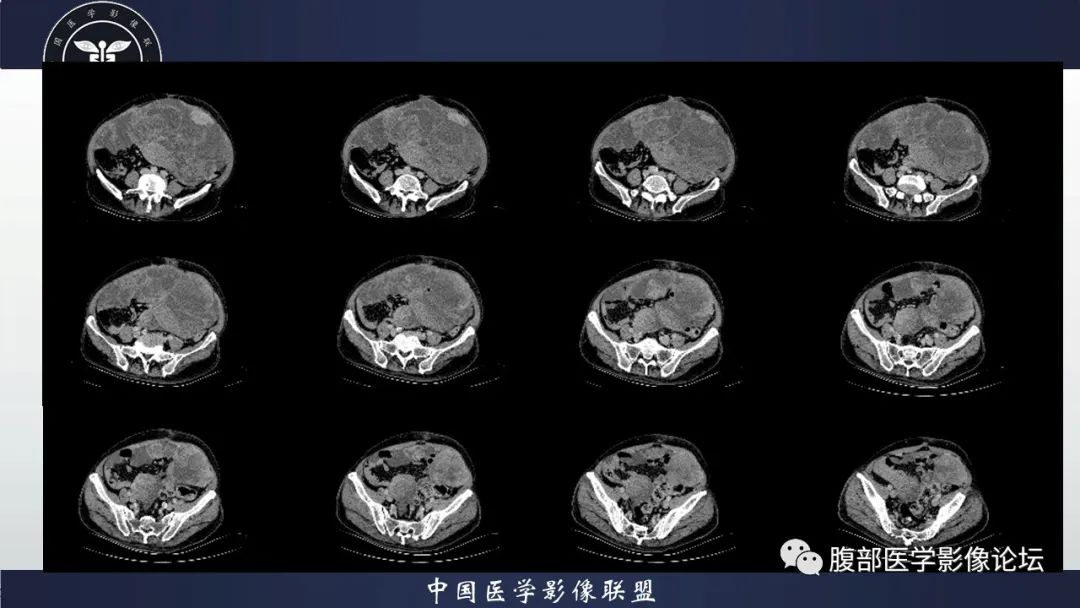 影像PPT - 【病例】腹腔恶性孤立性纤维性肿瘤1例CT影像-18