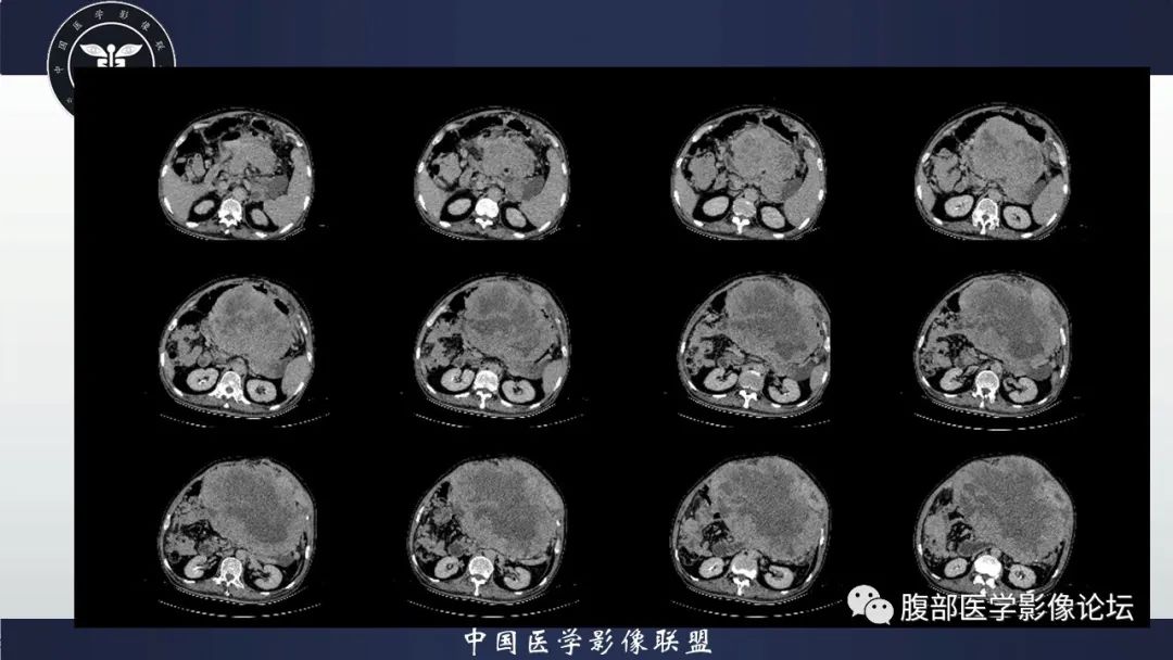 影像PPT - 【病例】腹腔恶性孤立性纤维性肿瘤1例CT影像-20