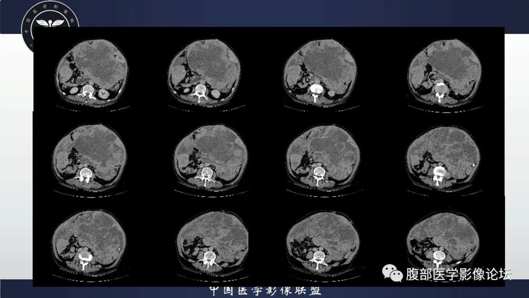 影像PPT - 【病例】腹腔恶性孤立性纤维性肿瘤1例CT影像-21