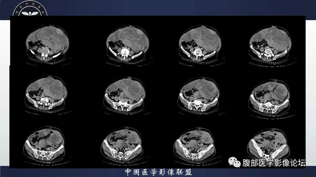 影像PPT - 【病例】腹腔恶性孤立性纤维性肿瘤1例CT影像-22