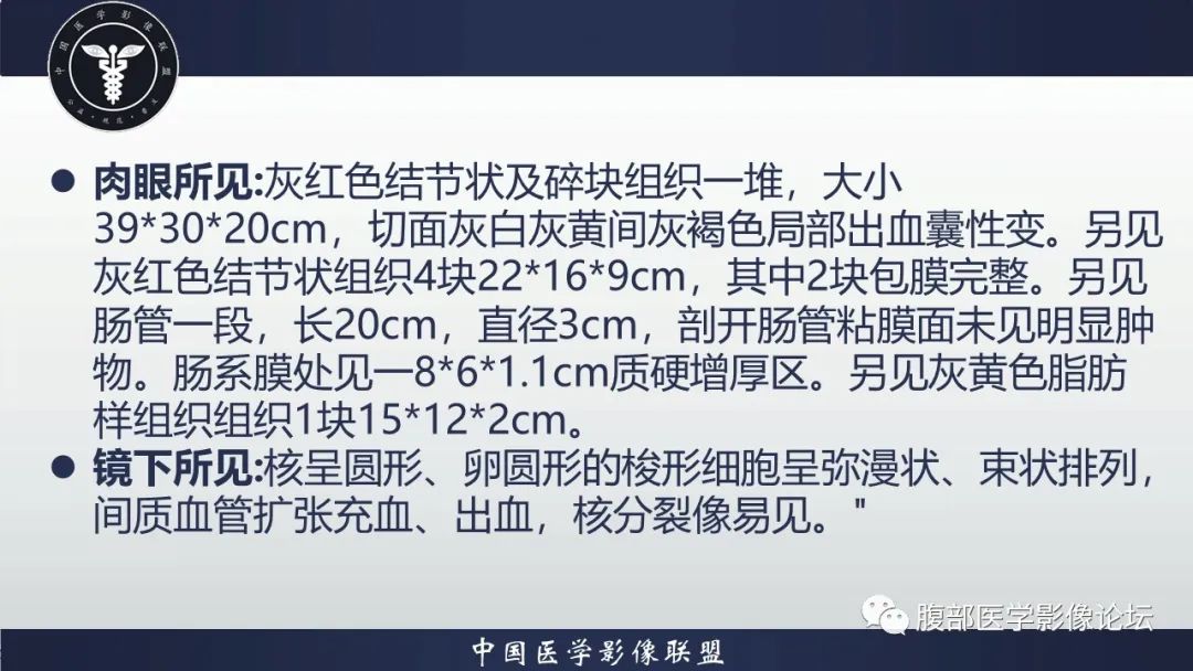 影像PPT - 【病例】腹腔恶性孤立性纤维性肿瘤1例CT影像-24