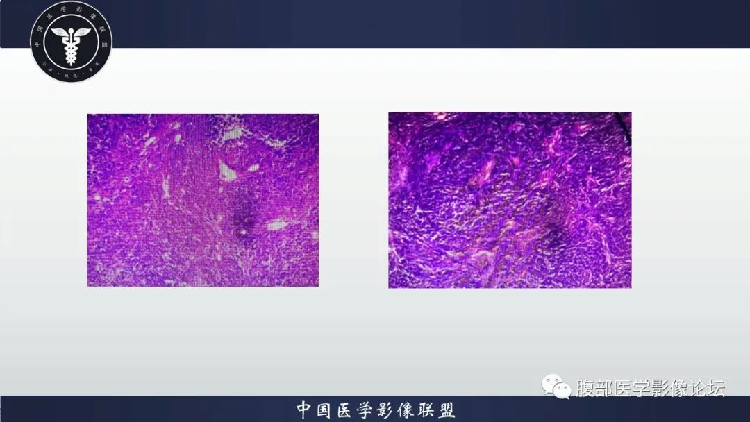 影像PPT - 【病例】腹腔恶性孤立性纤维性肿瘤1例CT影像-26