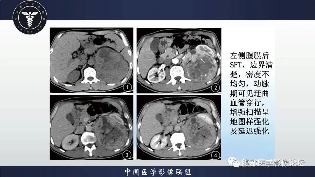 影像PPT - 【病例】腹腔恶性孤立性纤维性肿瘤1例CT影像-33
