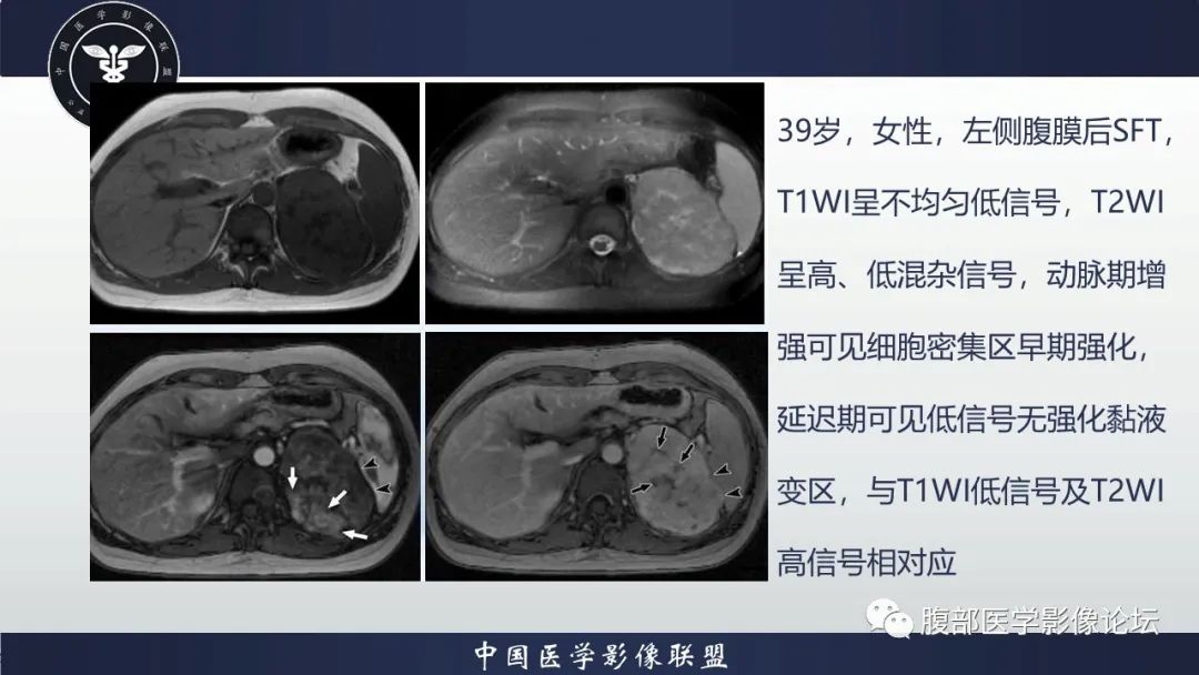 影像PPT - 【病例】腹腔恶性孤立性纤维性肿瘤1例CT影像-36
