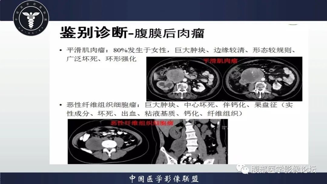 影像PPT - 【病例】腹腔恶性孤立性纤维性肿瘤1例CT影像-37