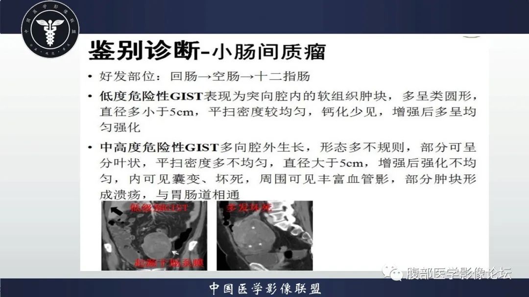 影像PPT - 【病例】腹腔恶性孤立性纤维性肿瘤1例CT影像-38