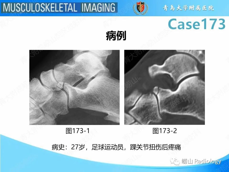 影像PPT - 【PPT】跟骨前突骨折-2