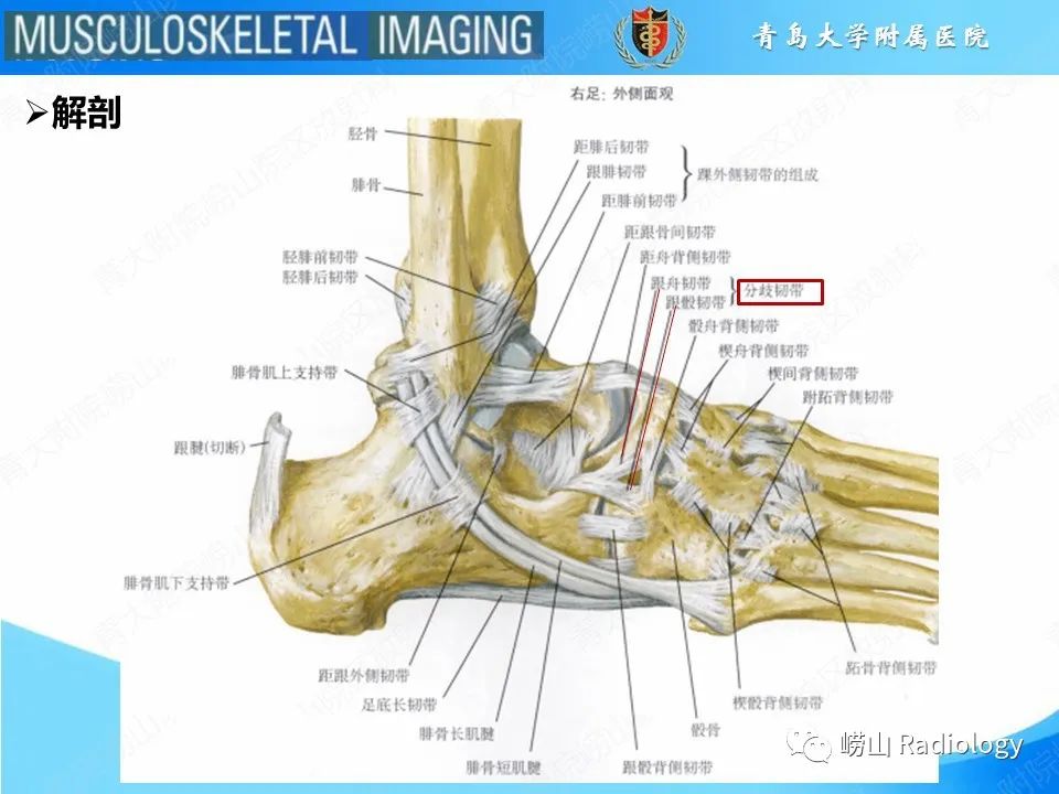 影像PPT - 【PPT】跟骨前突骨折-13