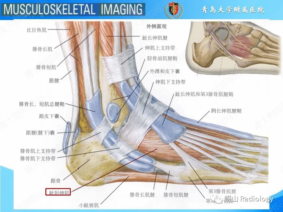 影像PPT - 【PPT】跟骨前突骨折-14