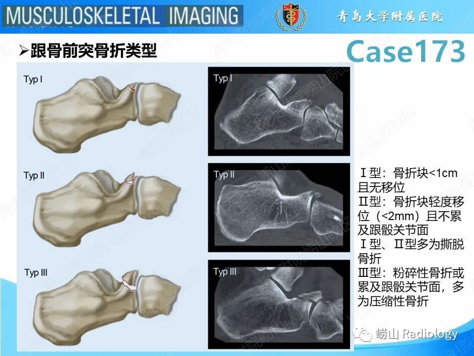 影像PPT - 【PPT】跟骨前突骨折-16