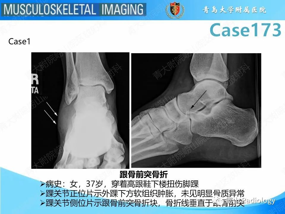影像PPT - 【PPT】跟骨前突骨折-17