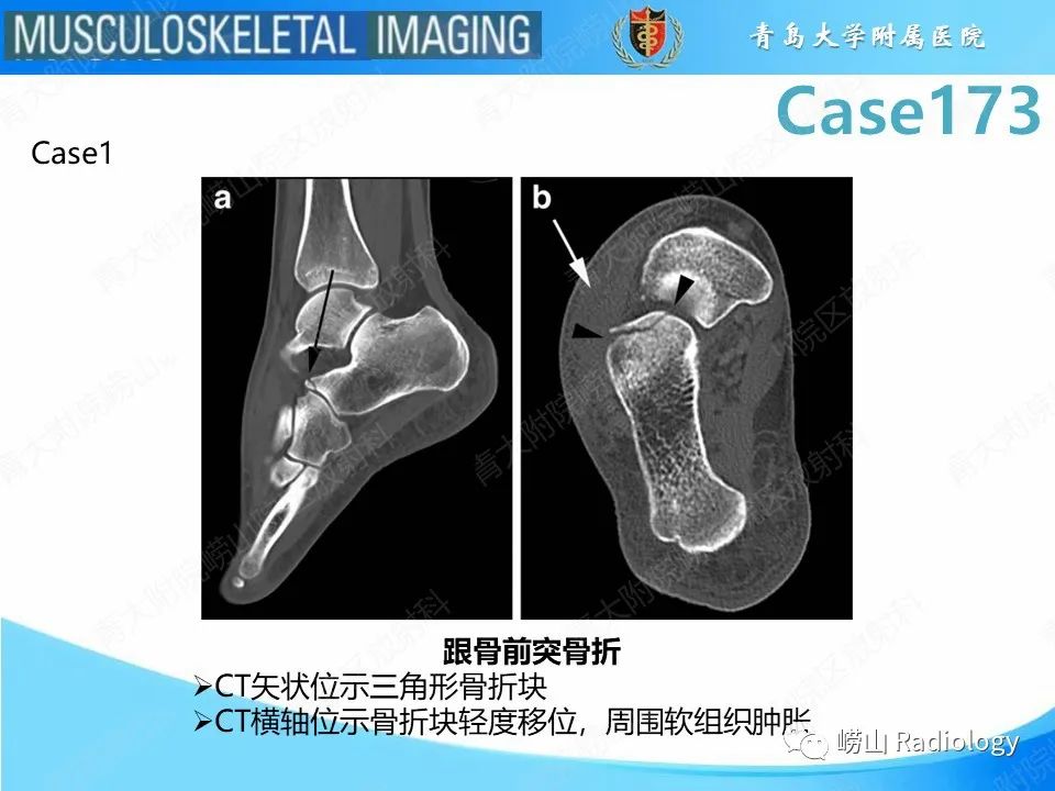 影像PPT - 【PPT】跟骨前突骨折-18