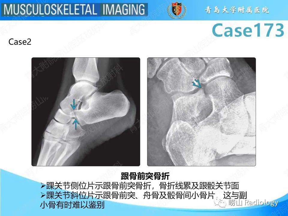 影像PPT - 【PPT】跟骨前突骨折-19
