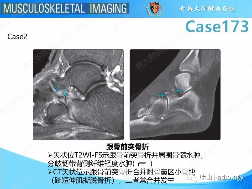 影像PPT - 【PPT】跟骨前突骨折-20