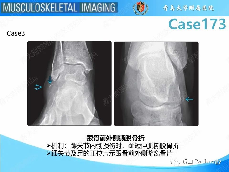 影像PPT - 【PPT】跟骨前突骨折-21