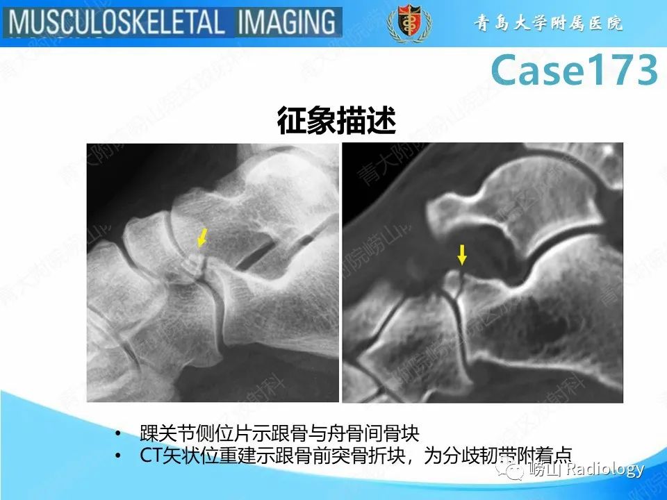 影像PPT - 【PPT】跟骨前突骨折-22