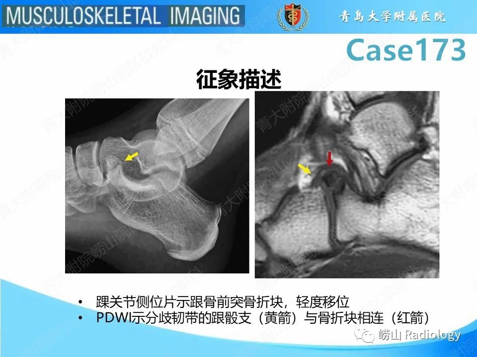 影像PPT - 【PPT】跟骨前突骨折-23