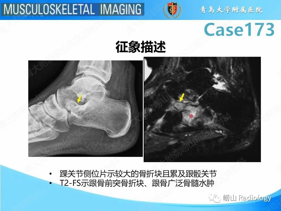 影像PPT - 【PPT】跟骨前突骨折-24